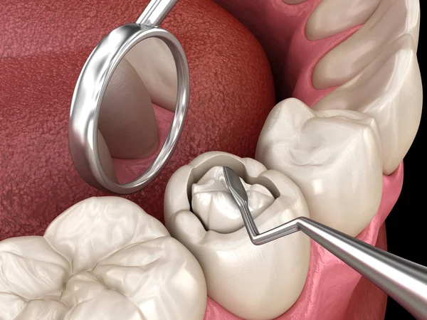 Restauração Dentária Deteriorada Com Enchimento Composto Ilustração Dente Medicamente Precisa — Fotografia de Stock