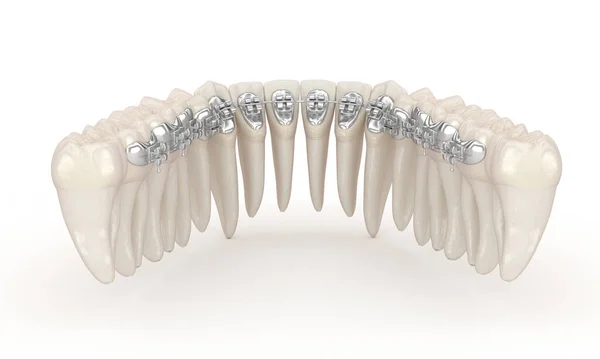 Dentes Aparelhos Claros Conceito Ilustração — Fotografia de Stock