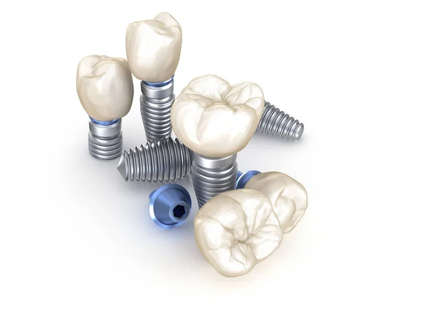 Implantes Dentales Ilustración Concepto Dientes Humanos — Foto de Stock