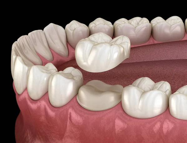 Готовый Зуб Размещения Зубной Коронки Медицинская Точность Иллюстрации — стоковое фото
