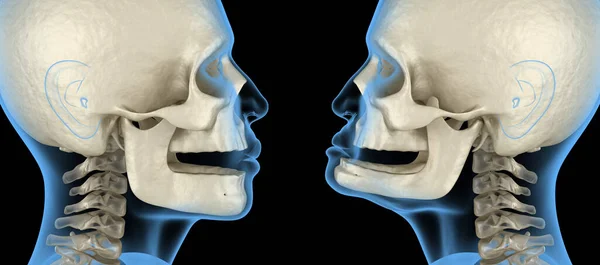 Onderkaak Botrecessie Het Verliezen Van Tanden Medisch Nauwkeurige Tandheelkundige Illustratie — Stockfoto