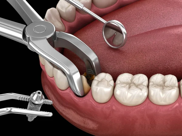 Extração Implante Cirurgia Imediata Complexa Ilustração Medicamente Precisa Tratamento Dentário — Fotografia de Stock