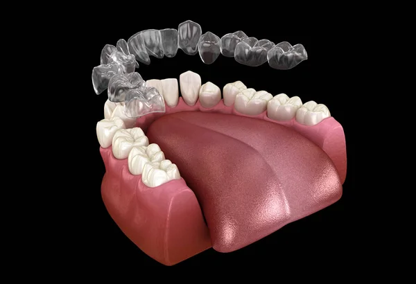 Invisalign Aparelhos Retentor Invisível Fazer Correção Mordida Ilustração Medicamente Precisa — Fotografia de Stock