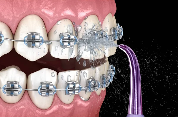 Irrigator cleaning braces with water jet. Medically accurate 3D illustration of oral hygiene.