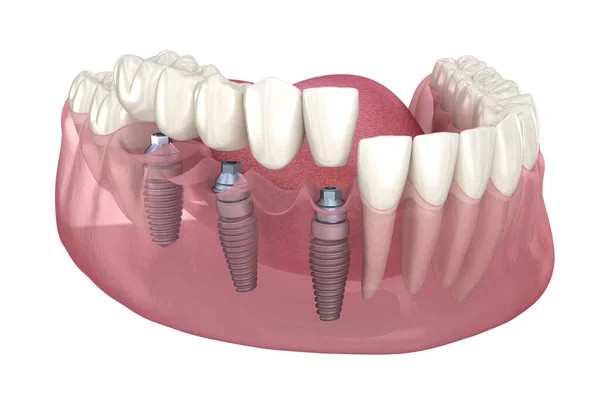 インプラント3本による歯科用ブリッジ 人間の歯と入れ歯の概念の医学的に正確な3Dイラスト — ストック写真