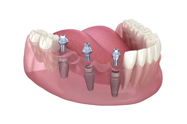 Fogászati Híd Implantátum Alapján Orvosilag Pontos Illusztráció Emberi Fogak Műfogsor — Stock Fotó