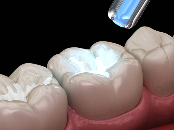 Restauração Dentes Com Lâmpada Enchimento Polimerização Ilustração Dente Medicamente Precisa — Fotografia de Stock