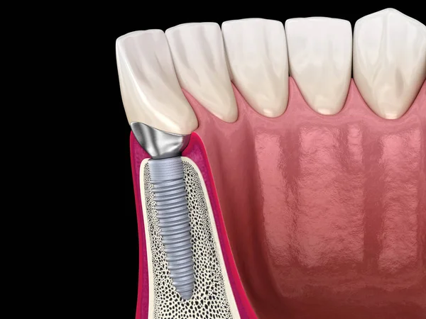 Maßgeschneiderter Aufbau Zahnimplantat Und Keramikkrone Medizinisch Korrekte Darstellung Der Zähne — Stockfoto