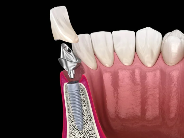 Нетиповий Абатмент Імплантація Зубів Керамічна Корона Медично Точна Ілюстрація Зуба — стокове фото