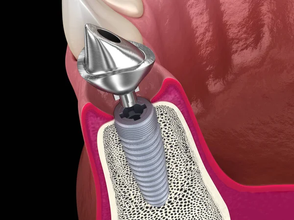 定制基托 假牙植入物和陶瓷冠 医学上准确的牙齿3D图像 — 图库照片
