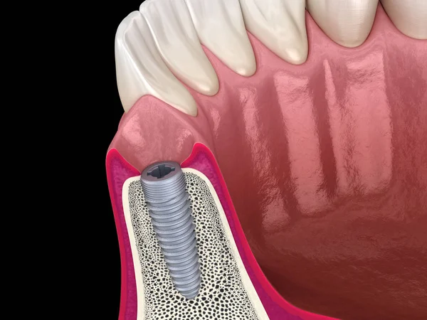 Zainstalowałem Implantację Dentystyczną Medycznie Dokładna Ilustracja Zęba — Zdjęcie stockowe