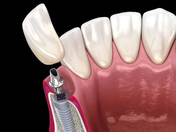 Standard Aufbau Zahnimplantat Und Keramikkrone Medizinisch Korrekte Darstellung Der Zähne — Stockfoto