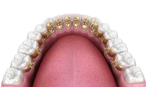 Dientes Sanos Con Tirantes Oro Concepto Dientes Blancos Ilustración Dental —  Fotos de Stock