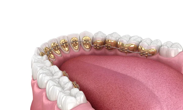 Dientes Sanos Con Tirantes Oro Concepto Dientes Blancos Ilustración Dental — Foto de Stock