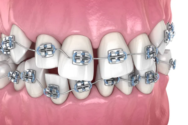 Dentes Anormais Posição Correção Com Aparelho Metálico Tretamento Ilustração Odontológica — Fotografia de Stock