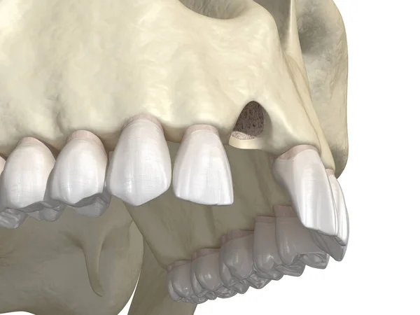 Αισθητικό Ελάττωμα Μετά Την Απώλεια Κεντρικό Δόντι Κοπτήρα Ιατρικά Ακριβής — Φωτογραφία Αρχείου