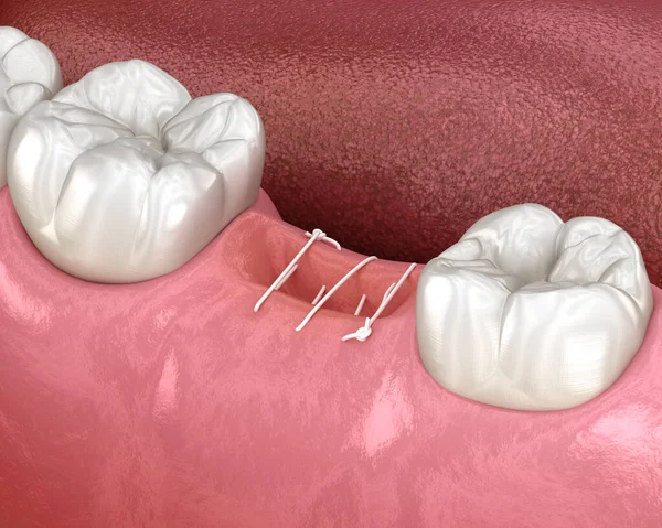 Stitches in gum after tooth extraction. 3D illustration of dental treatment