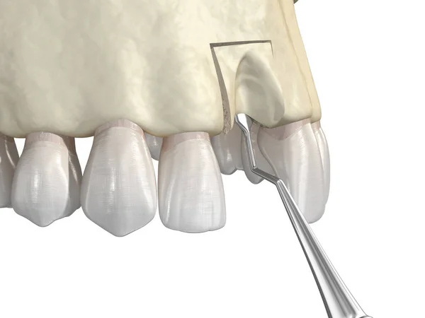 骨移植术 用骨块 牙植入进行骨增厚 医学上准确的3D图像 — 图库照片