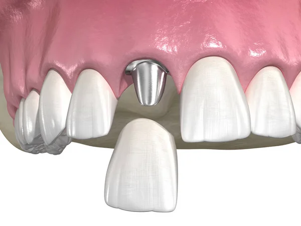 定制基托 假牙植入物和陶瓷冠 医学上准确的牙齿3D图像 — 图库照片