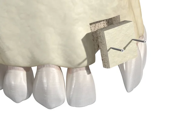 Przeszczepienie Kości Powiększenie Przy Użyciu Bloku Kości Implantacji Zębów Medycznie — Zdjęcie stockowe