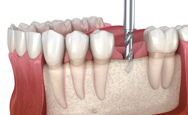 Буріння Кістки Розміщення Зубних Імплантатів Медично Точна Ілюстрація Концепції Зубів — стокове фото