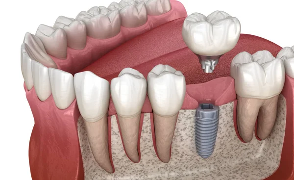 Установка Зубной Короны Поверх Имплантата Медицинская Точность Иллюстрации Концепции Человеческих — стоковое фото