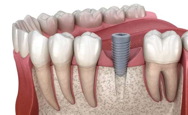 Implant Abutment Installation Procedure Medically Accurate Illustration Human Teeth Dentures — Stock Photo, Image