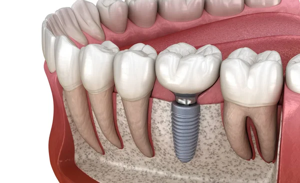 Molar Tooth Crown Installation Implant Abutment Medically Accurate Illustration Human — 图库照片