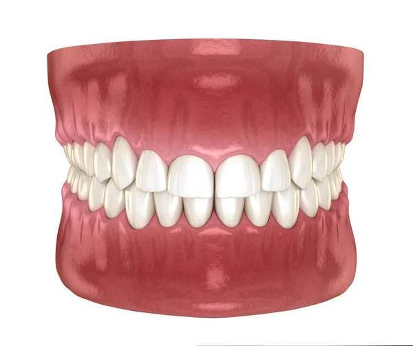 Frontal Crown Lengthening Esthetic Surgery Medically Accurate Dental Illustration — Fotografia de Stock