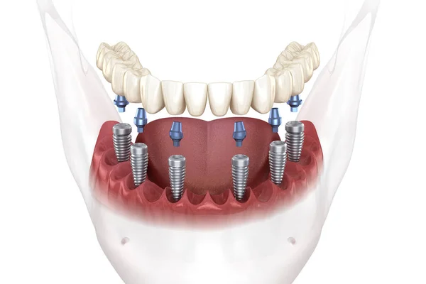 Removable Mandibular Prosthesis All System Supported Implants Medically Accurate Illustration — 스톡 사진