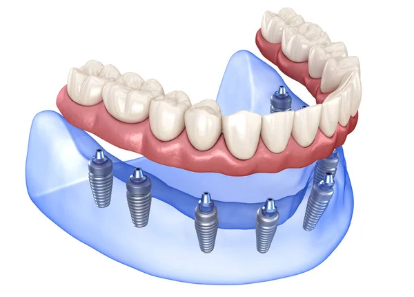 Kiefer Und Unterkieferprothese Mit Zahnfleisch All System Das Durch Implantate — Stockfoto