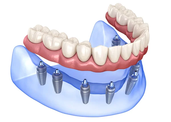 Prothèse Maxillaire Mandibulaire Avec Gomme Tout Sur Système Soutenu Par — Photo