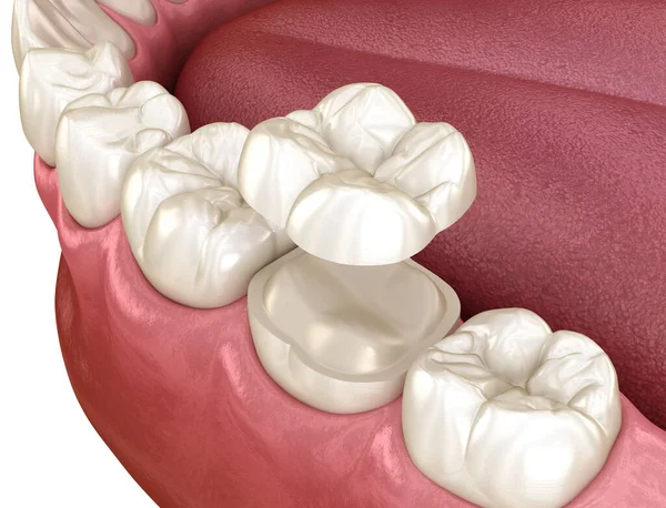 Onlay Ceramic Crown Fixation Molar Tooth Medically Accurate Illustration Human — Stock Photo, Image