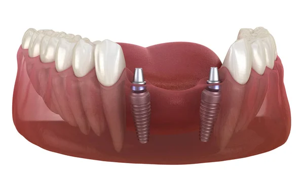 Diş Köprüsü Implantlarla Destekleniyor Diş Konseptinin Tıbben Doğru Animasyonu — Stok fotoğraf