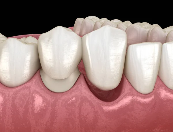 Ponte Sbalzo Ceramica Recupero Dente Frontale Animazione Clinicamente Accurata Del — Foto Stock