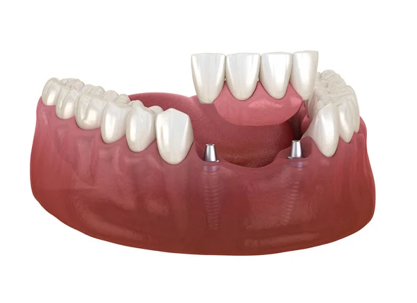 Przedni Most Zębowy Wspomagany Implantami Medycznie Dokładna Animacja Koncepcji Stomatologicznej — Zdjęcie stockowe