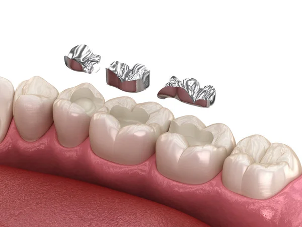 Amalgamrestaurierung Medizinisch Korrekte Animation Des Zahnärztlichen Konzepts — Stockfoto
