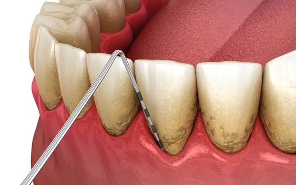 Badanie Periodontitis Proces Recesji Dziąseł Medycznie Dokładna Ilustracja — Zdjęcie stockowe