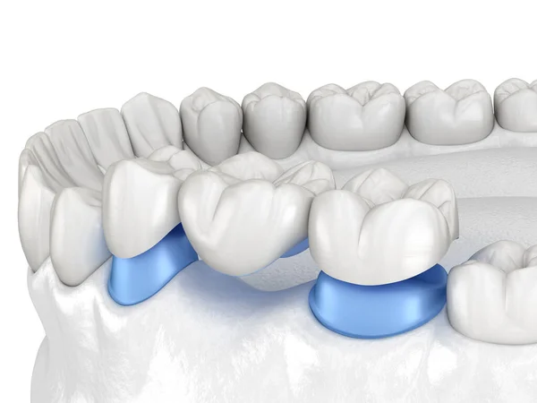 磁器臼歯と前臼歯の上に3歯の歯科ブリッジ 人間の歯の治療の医学的に正確な3Dイラスト — ストック写真