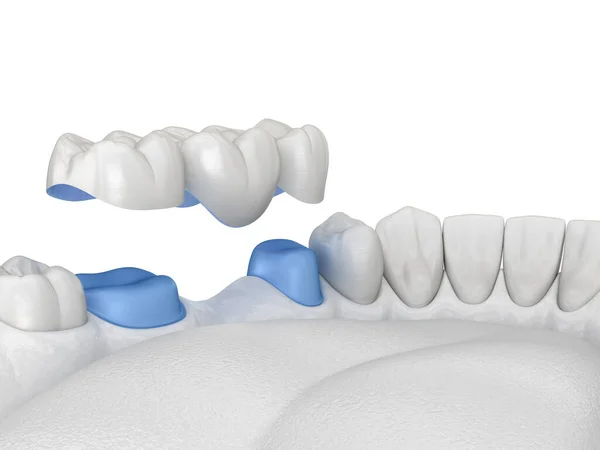 Porcelaine Pont Dentaire Dents Sur Molaire Prémolaire Illustration Médicalement Précise — Photo