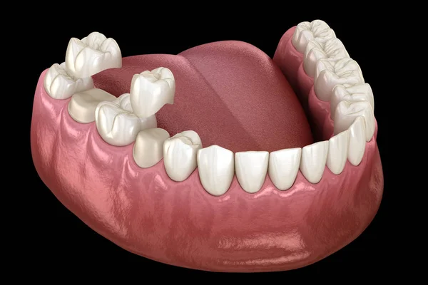Porcelain Crowns Placement Premolar Molar Teeth Medically Accurate Illustration — ストック写真