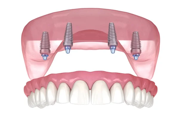 Proteza Maxillary Gumą Wszystko System Obsługiwany Przez Implanty Medycznie Dokładna — Zdjęcie stockowe