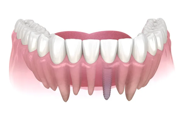 Premolär Tandåterhämtning Med Implantat Medicinskt Korrekt Illustration Mänskliga Tänder Och — Stockfoto