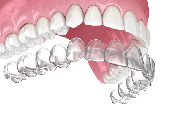 Invisalign Aparat Ortodontyczny Lub Niewidzialny Aparat Zęby Medycznie Dokładna Ilustracja — Zdjęcie stockowe