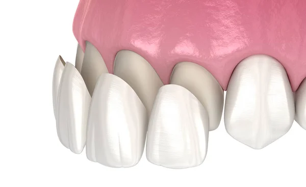 Veneer Installation Procedure Central Incisor Lateral Incisor Medically Accurate Tooth — Stock Photo, Image