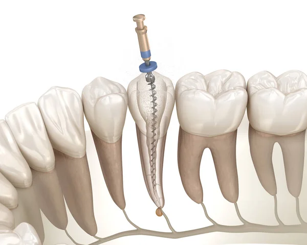 Endodontický Kořenový Kanálový Léčebný Proces Lékařsky Přesná Zubní Ilustrace — Stock fotografie