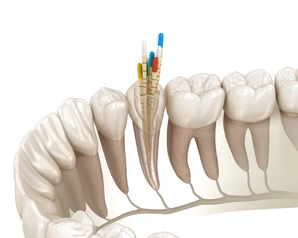 Endodontik Kanal Tedavisi Tıbbi Olarak Doğru Diş Illüstrasyon — Stok fotoğraf