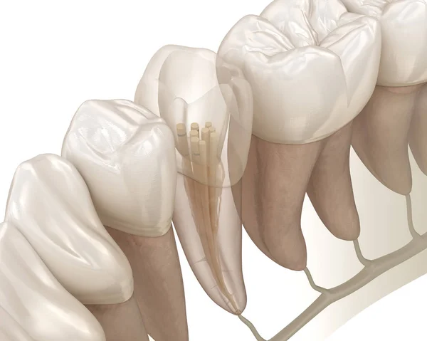 Процес Лікування Ендодонтичного Кореневого Каналу Медично Точна Ілюстрація Зуба — стокове фото
