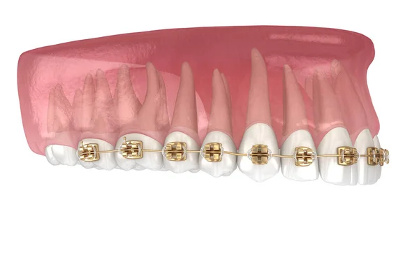 Golden Braces Tretament Macro View Medically Accurate Dental Illustration — Stock Photo, Image