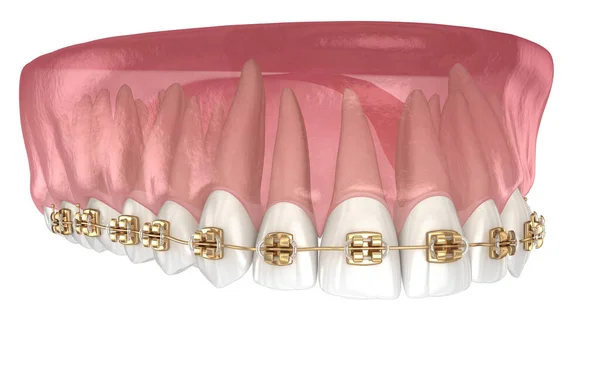 Golden Braces Tretament Macro View Medically Accurate Dental Illustration — Stock Photo, Image